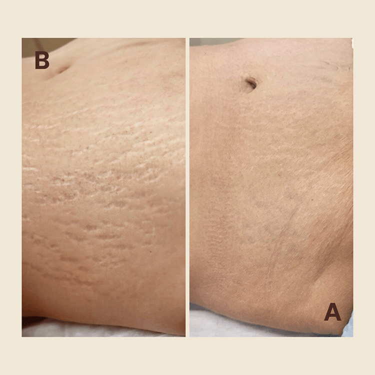 Stretch Mark Regeneration — by Natalia Mejia, NYC