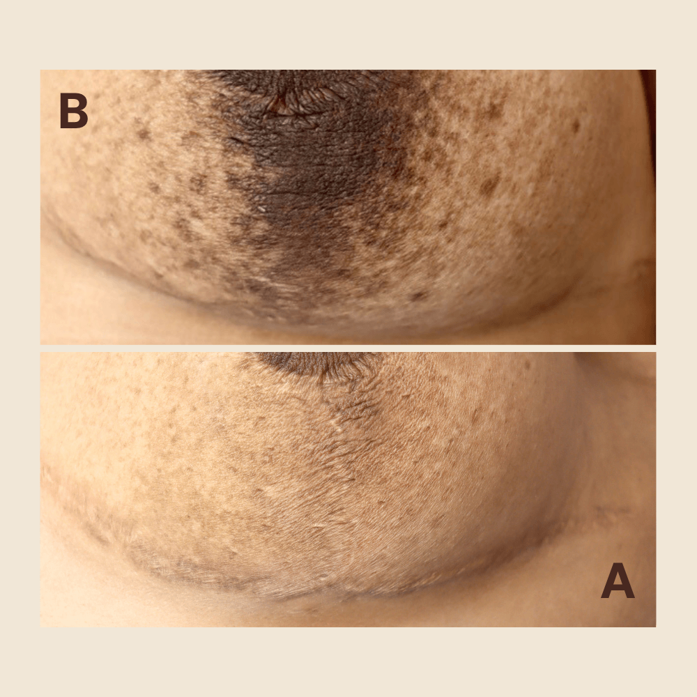 Scar Regeneration & Camouflage — by Natalia Mejia, NYC
