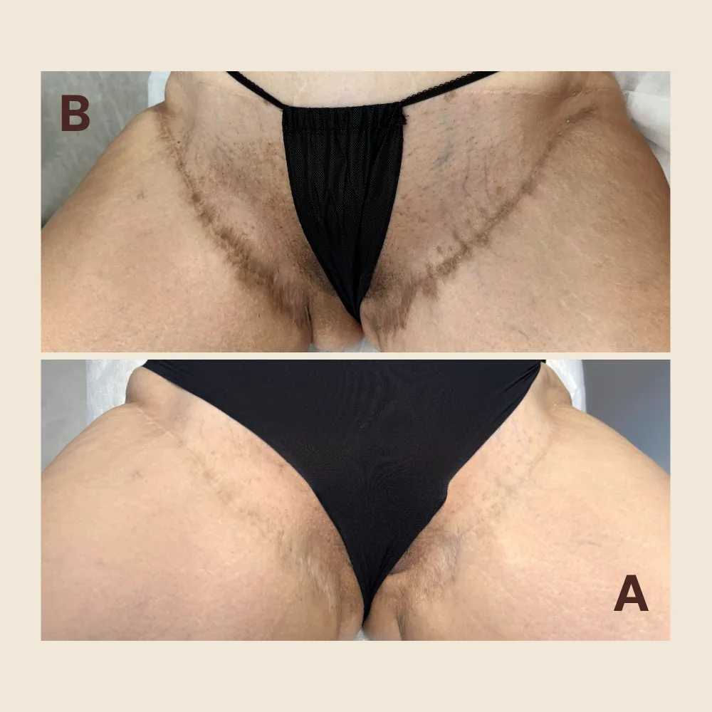 Scar Regeneration & Camouflage — Groin