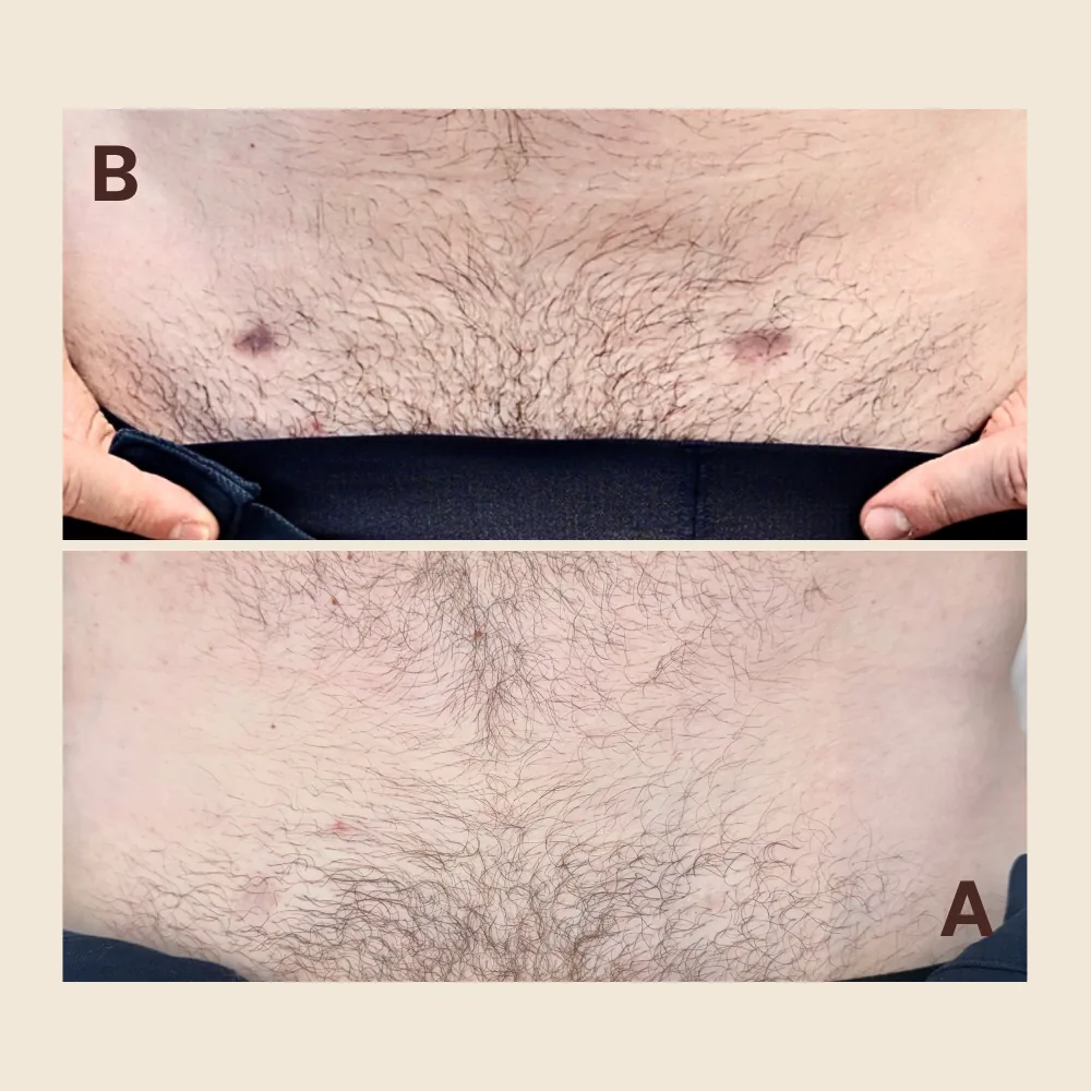 Scar Regeneration & Camouflage — Abdomen