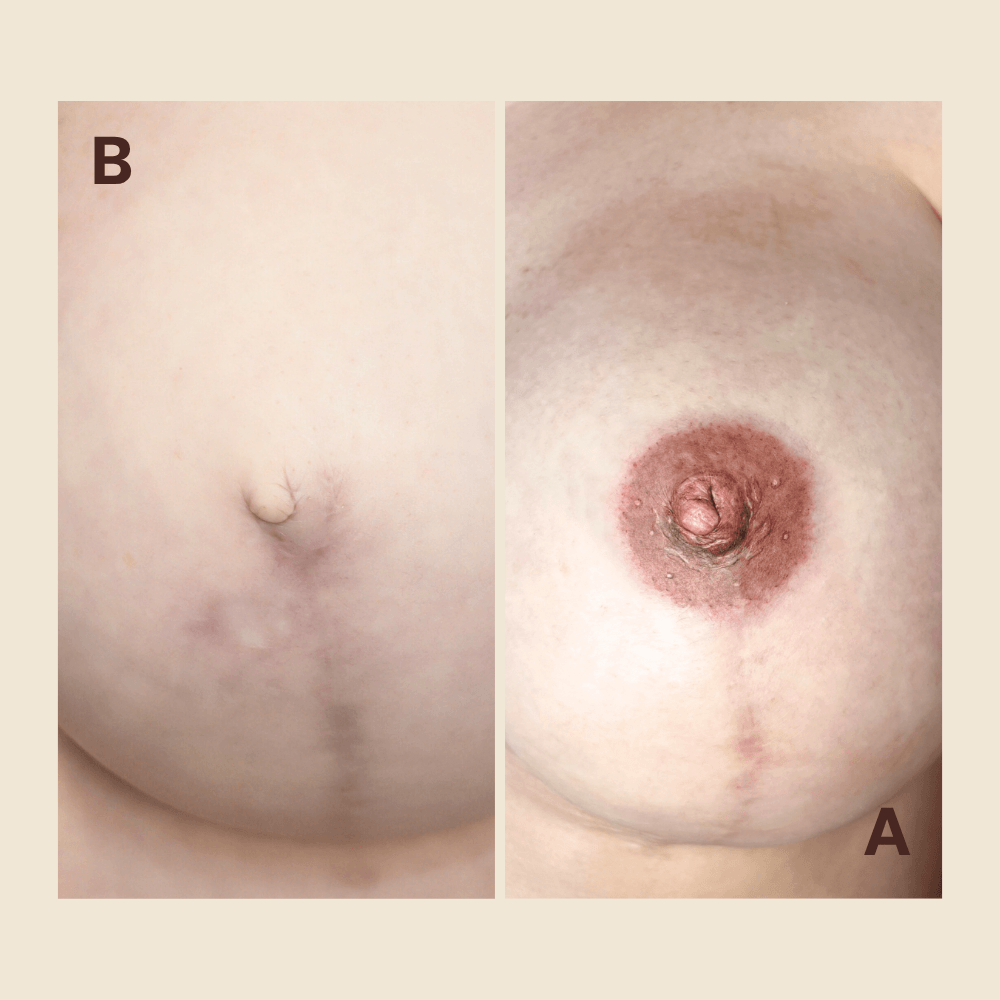 3D Areola & Nipple Tattoo — by Natalia Mejia, NYC