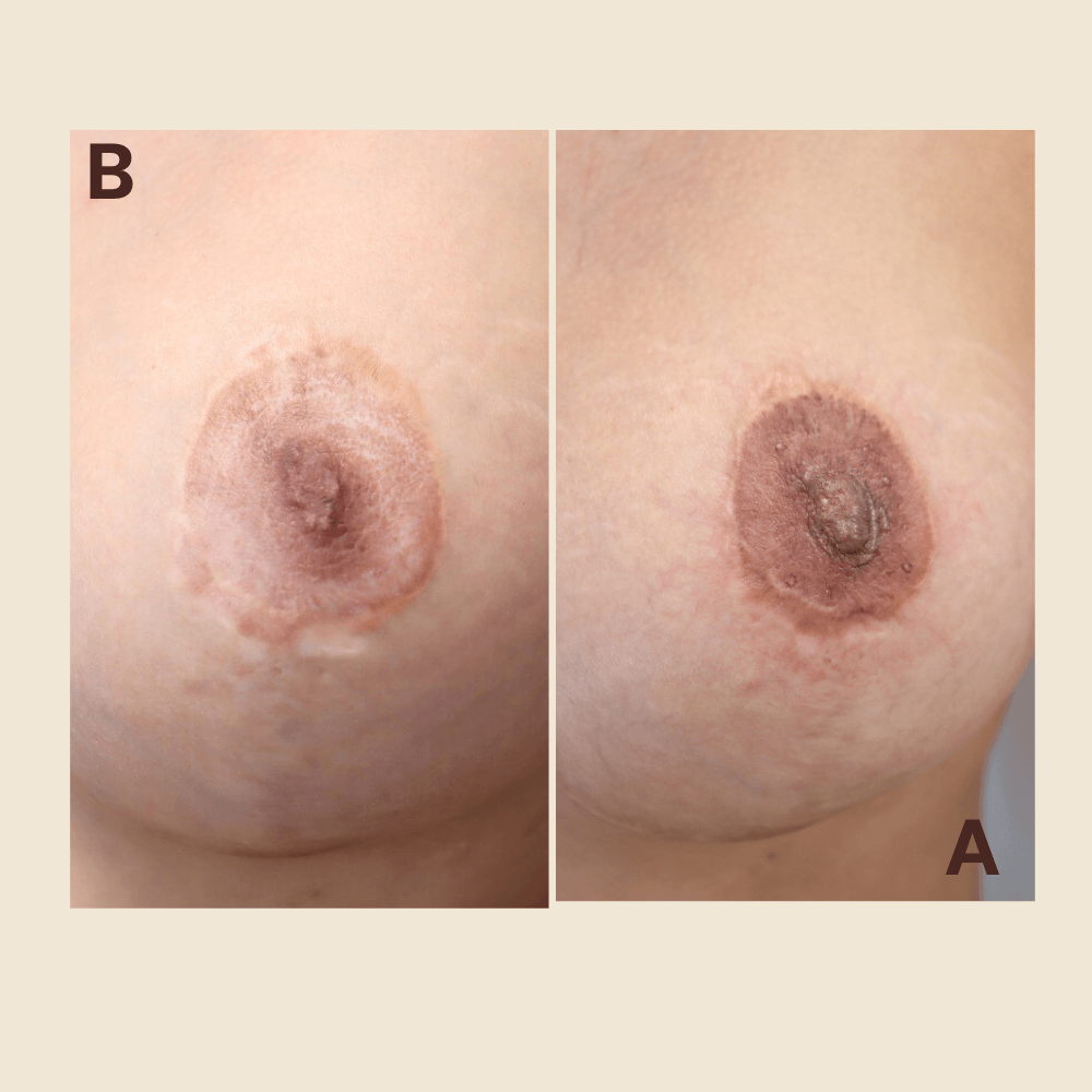 3D Areola & Nipple Tattoo — Breast