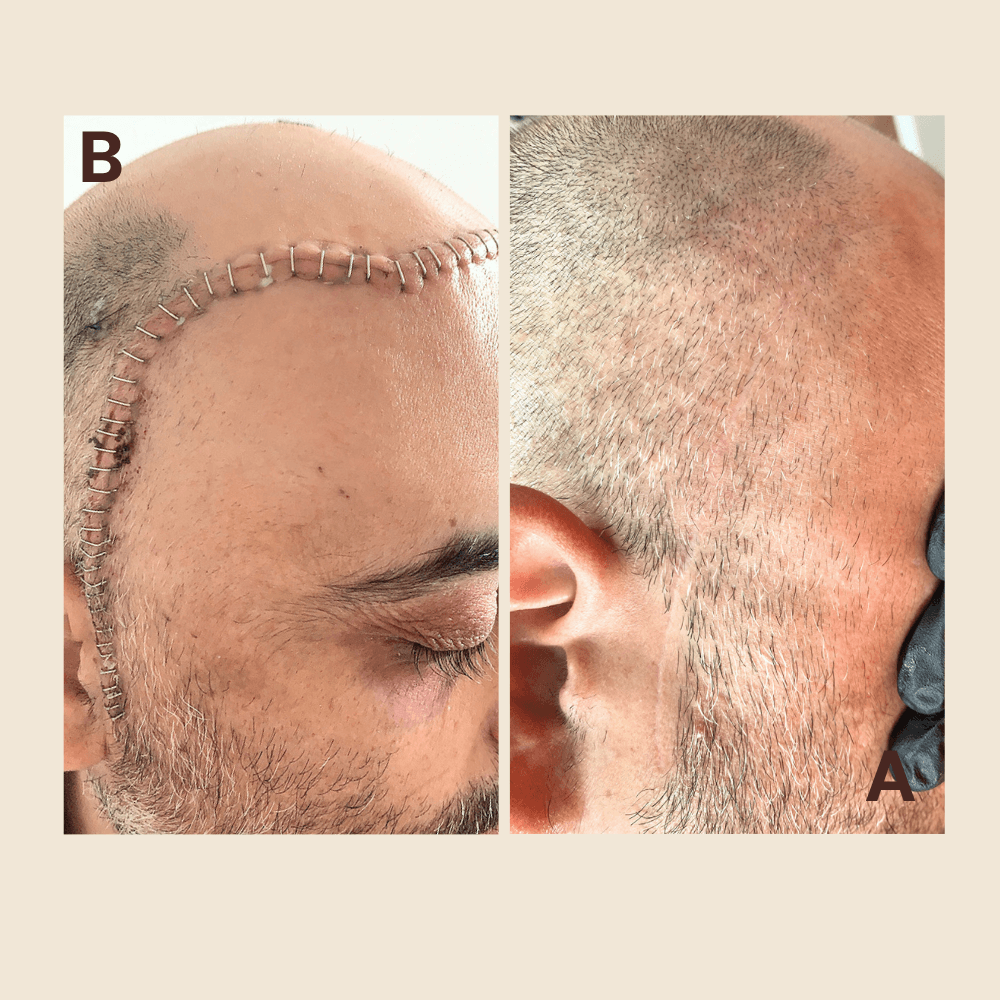 Scar Regeneration & Camouflage — Face