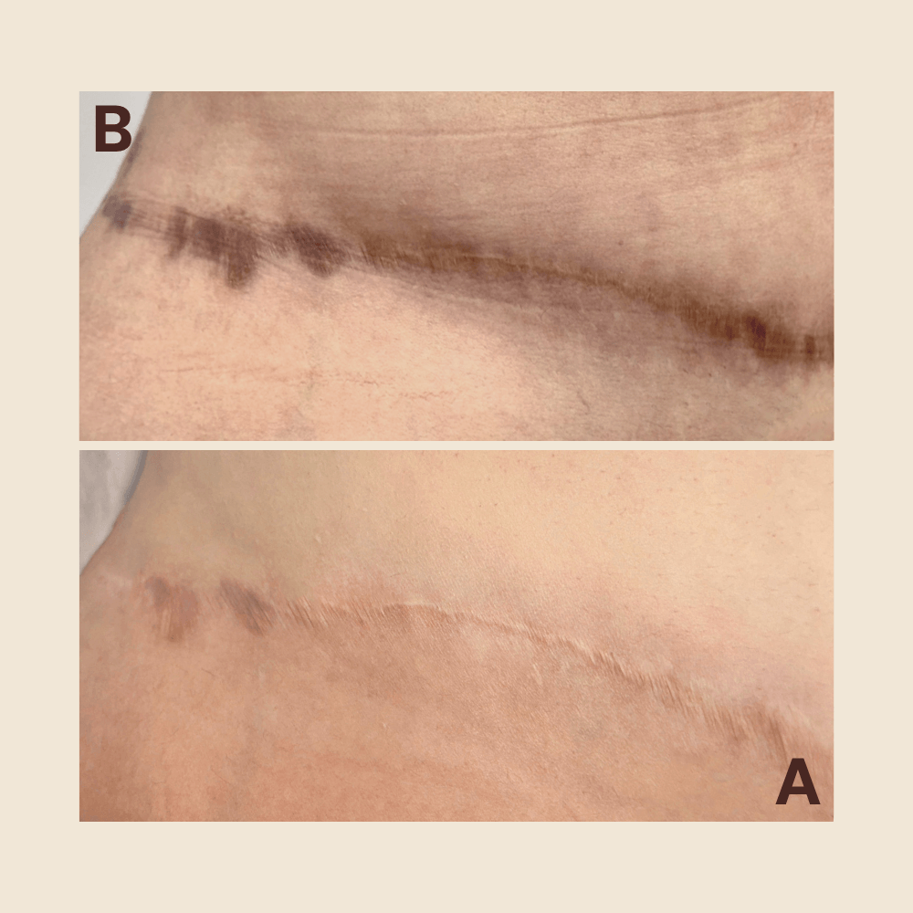 Scar Regeneration & Camouflage — Body